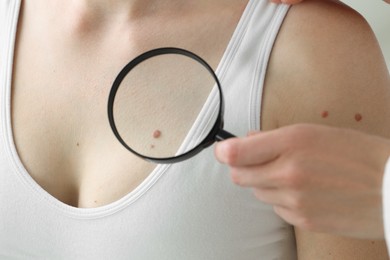 Photo of Doctor examining woman's mole with magnifying glass in clinic, closeup