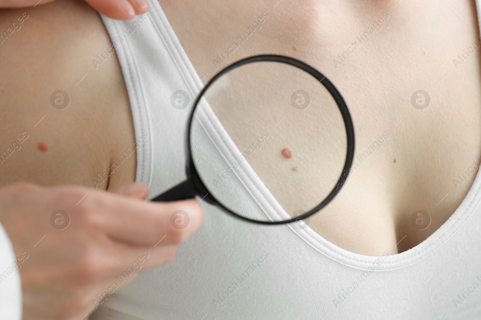 Photo of Doctor examining woman's mole with magnifying glass in clinic, closeup