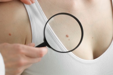 Photo of Doctor examining woman's mole with magnifying glass in clinic, closeup