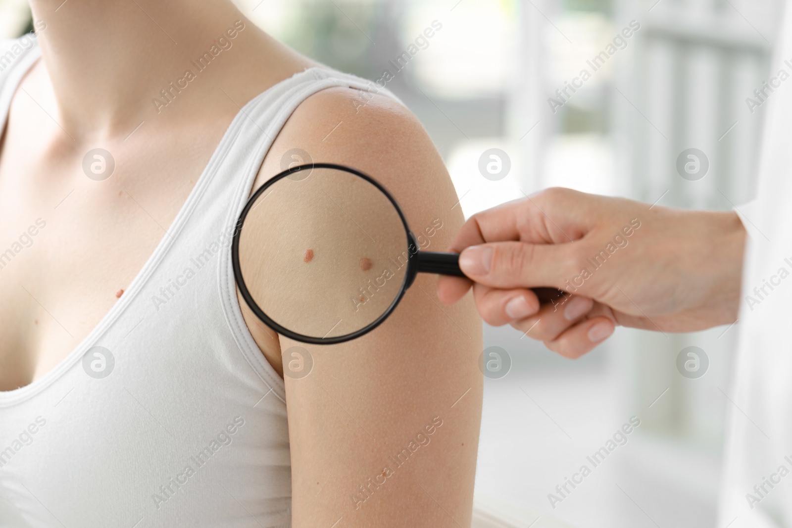 Photo of Doctor examining woman's mole with magnifying glass in clinic, closeup