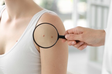 Doctor examining woman's mole with magnifying glass in clinic, closeup