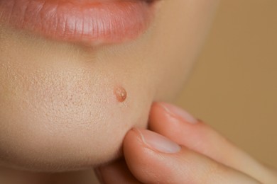 Photo of Woman with mole on her skin against beige background, closeup