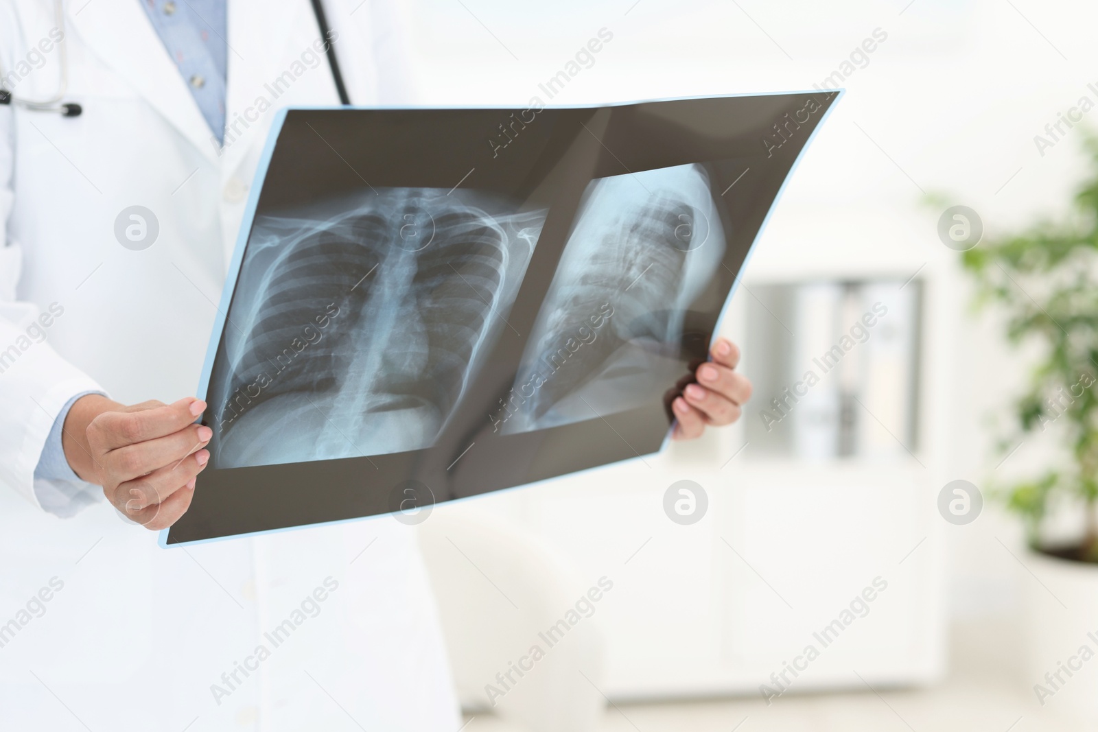 Photo of Lung disease. Doctor examining chest x-ray in clinic, closeup