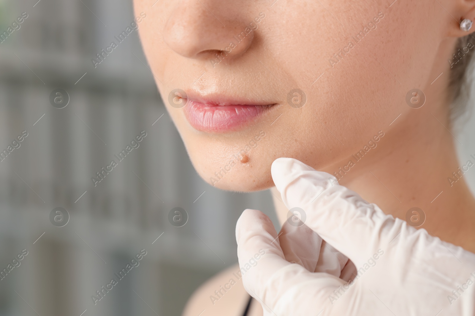 Photo of Doctor examining woman's mole in clinic, closeup