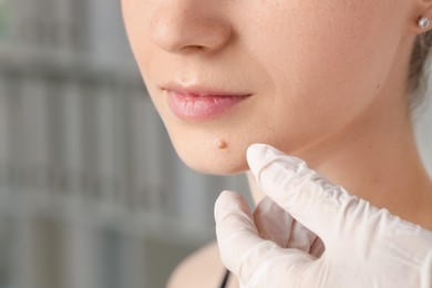 Photo of Doctor examining woman's mole in clinic, closeup