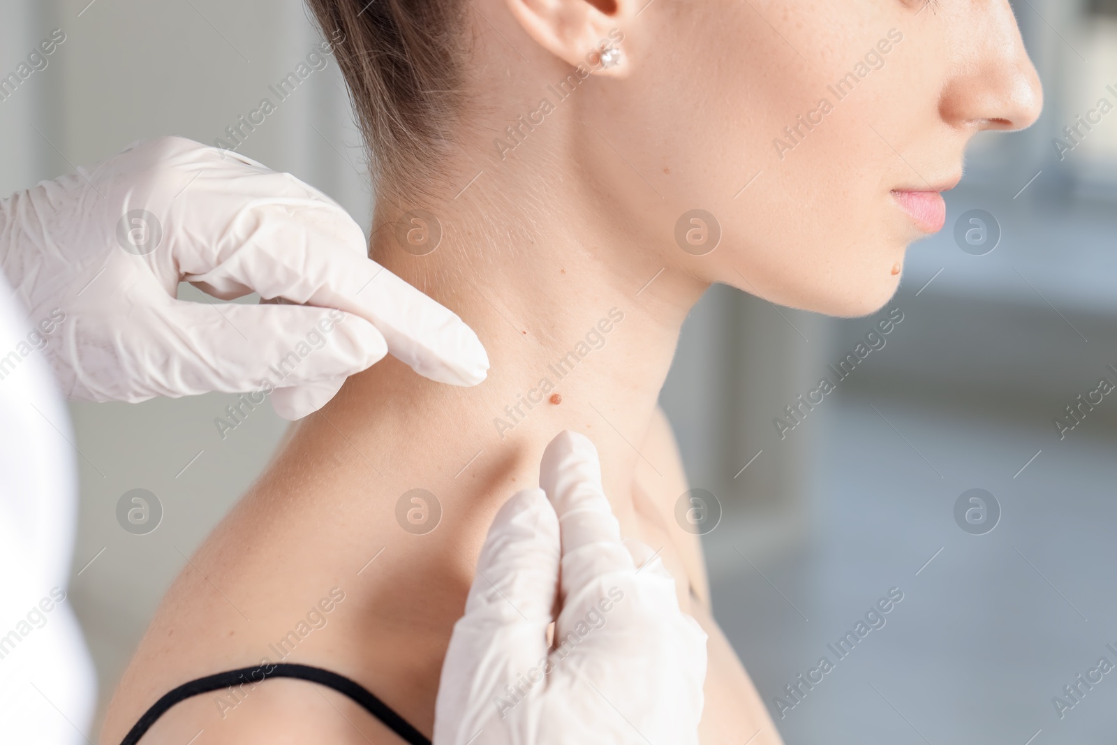 Photo of Doctor examining woman's mole in clinic, closeup