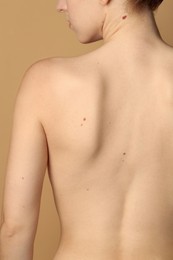 Photo of Woman with moles on her skin against beige background, back view