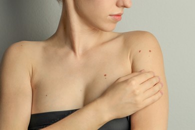 Photo of Woman with moles on her skin against light grey background, closeup