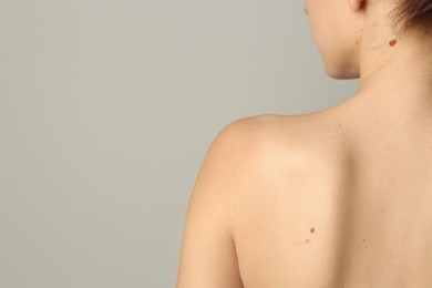 Photo of Woman with moles on her skin against light grey background, closeup. Space for text