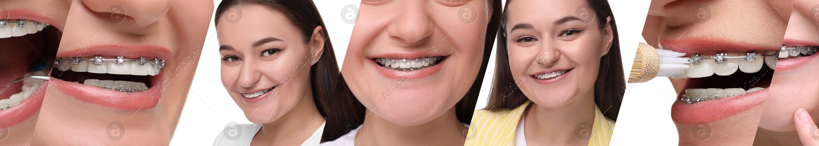 Image of Girl wearing braces on white background, collage of photos