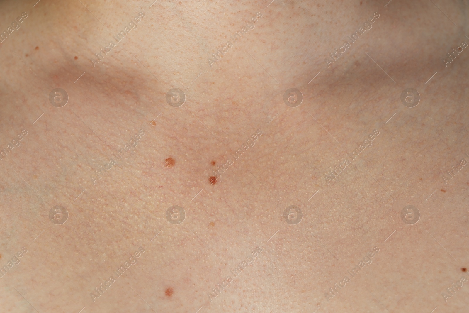 Photo of Man with birthmarks on his skin, closeup