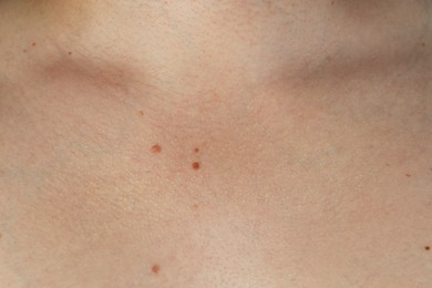 Man with birthmarks on his skin, closeup