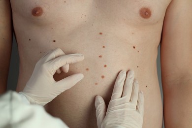 Photo of Dermatologist in gloves examining patient's birthmarks, closeup