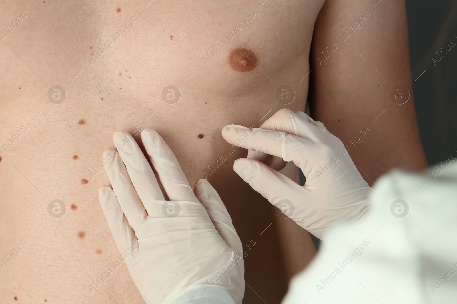 Photo of Dermatologist in gloves examining patient's birthmark, closeup