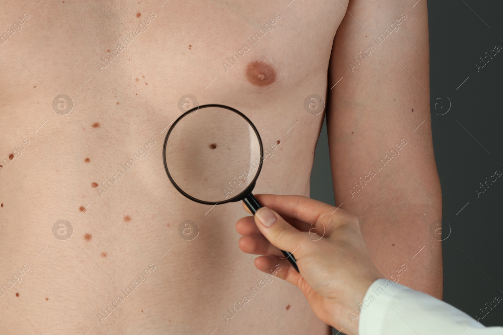 Photo of Dermatologist examining patient's birthmark with magnifying glass on grey background, closeup