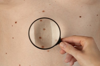 Dermatologist examining patient's birthmarks with magnifying glass, closeup