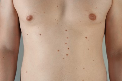 Man with birthmarks on his skin against grey background, closeup