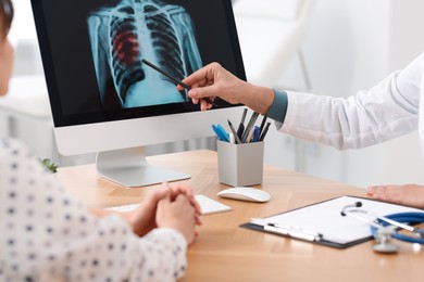 Photo of Lung cancer. Doctor showing chest x-ray to her patient in clinic, closeup