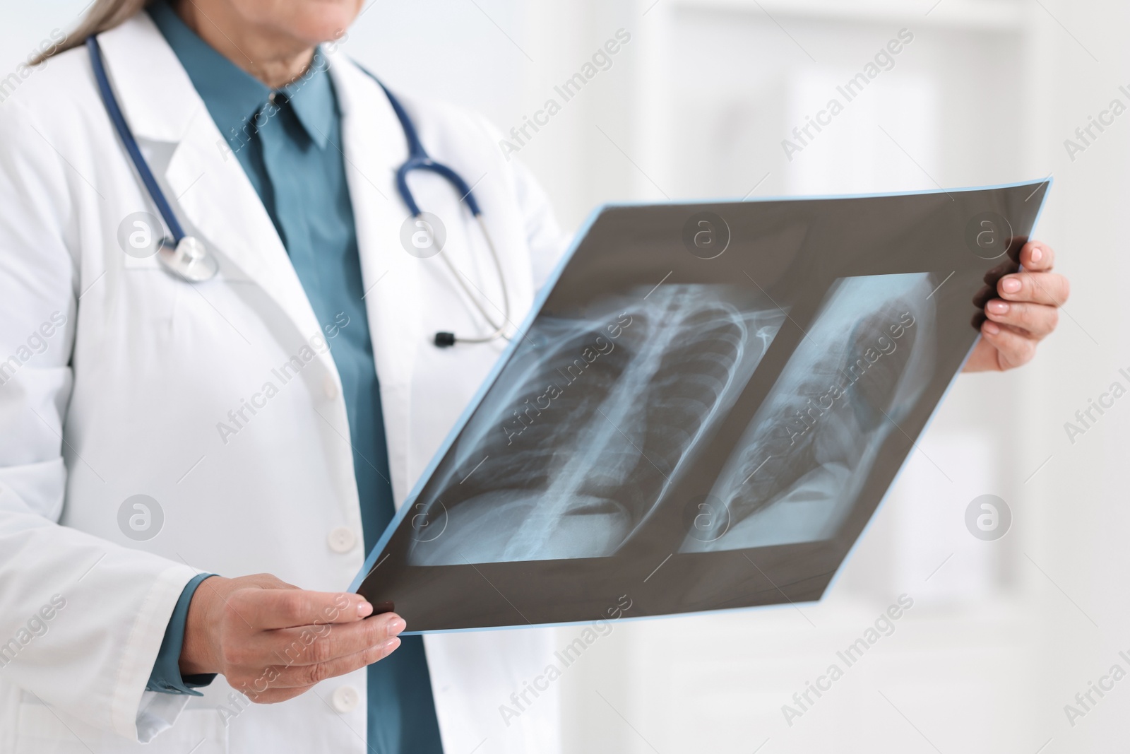 Photo of Lung disease. Doctor examining chest x-ray in clinic, closeup