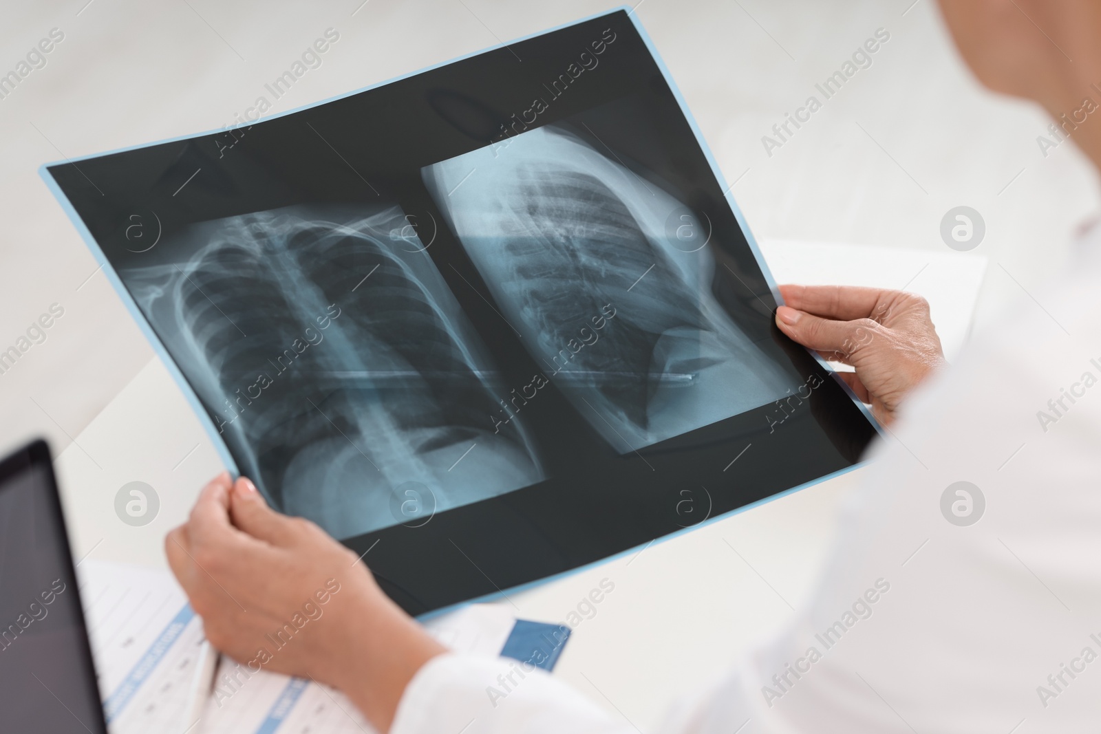 Photo of Lung disease. Doctor examining chest x-ray in clinic, closeup