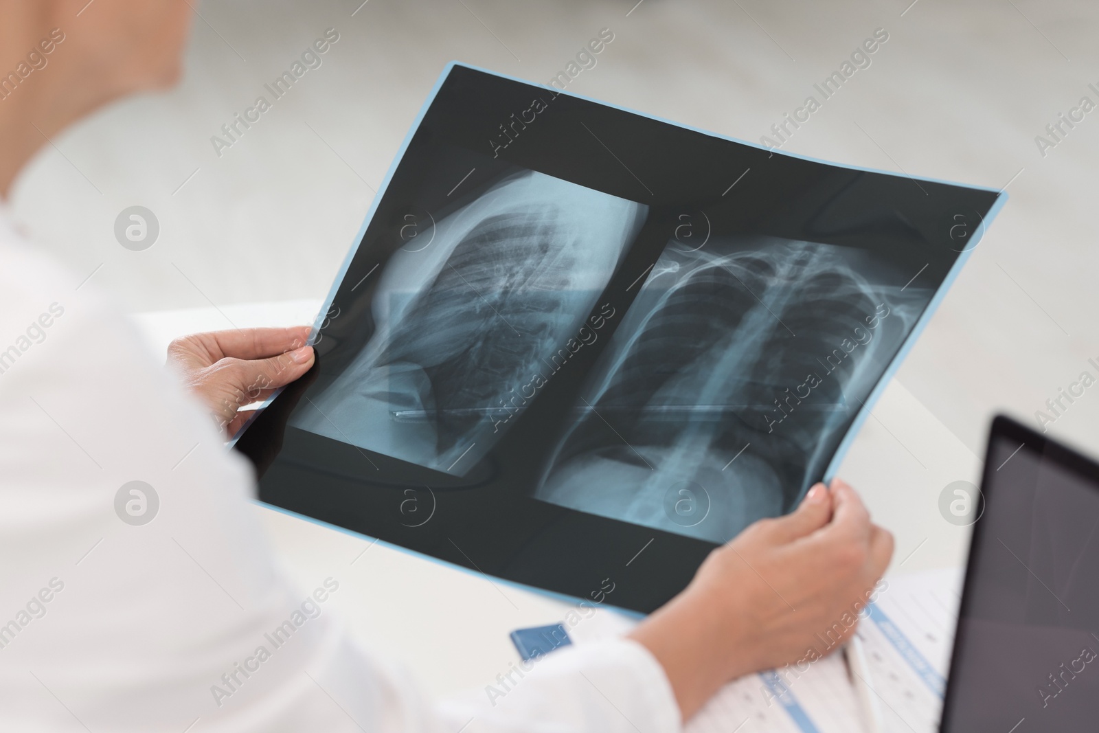 Photo of Lung disease. Doctor examining chest x-ray in clinic, closeup