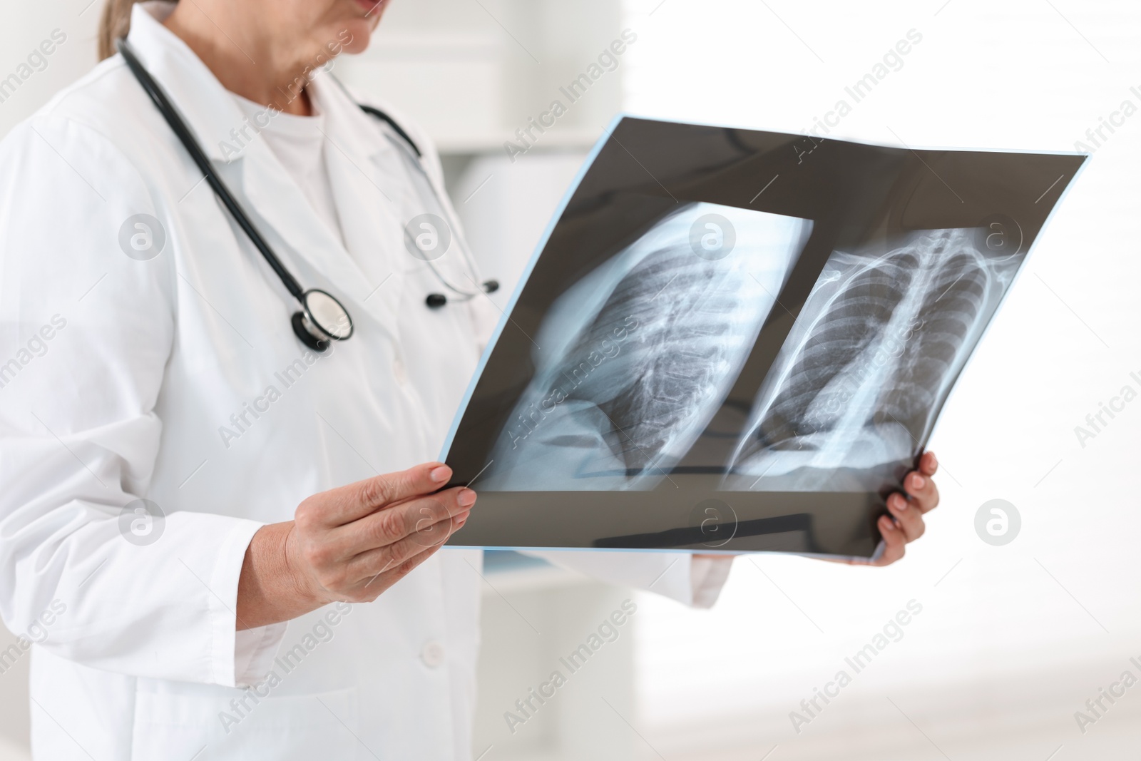 Photo of Lung disease. Doctor examining chest x-ray in clinic, closeup