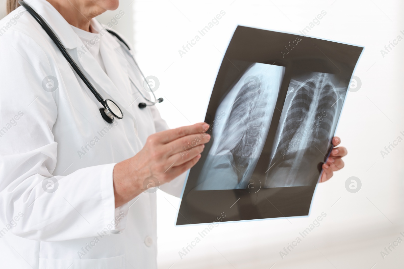 Photo of Lung disease. Doctor examining chest x-ray in clinic, closeup