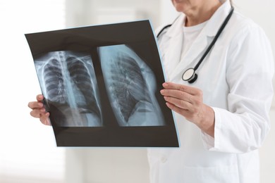 Photo of Lung disease. Doctor examining chest x-ray in clinic, closeup