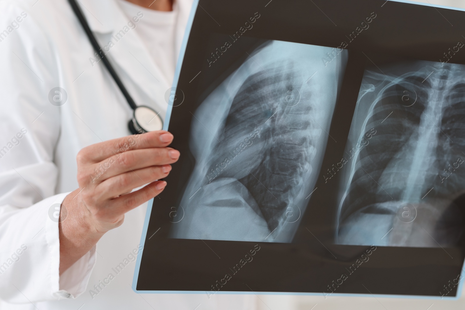 Photo of Lung disease. Doctor examining chest x-ray in clinic, closeup