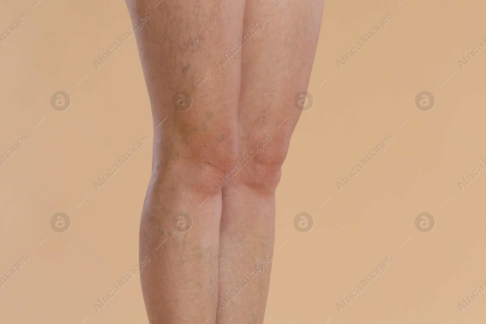 Photo of Woman with varicose veins on beige background, closeup