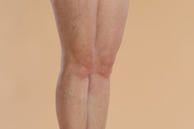 Woman with varicose veins on beige background, closeup