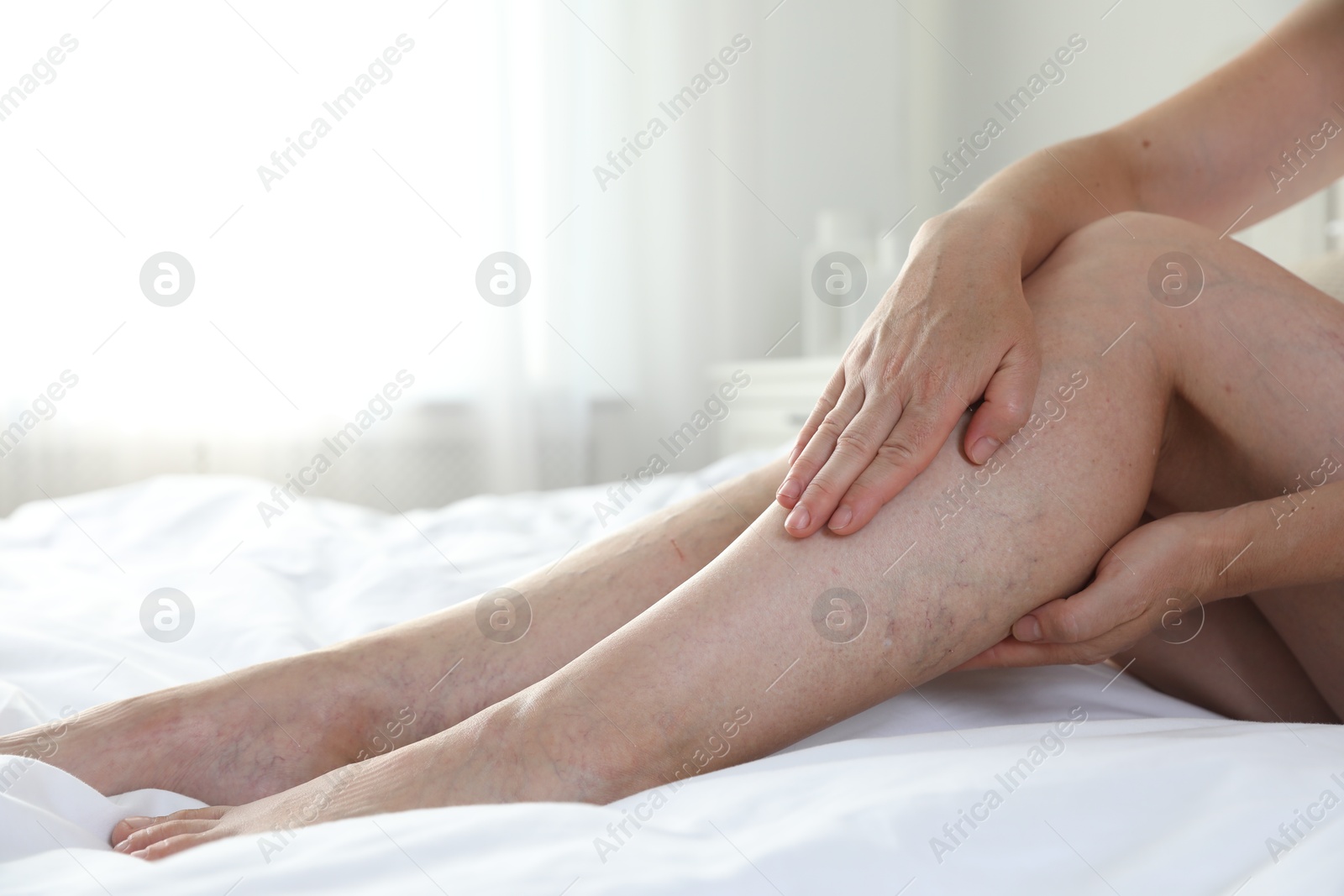 Photo of Woman suffering from varicose veins on bed indoors, closeup