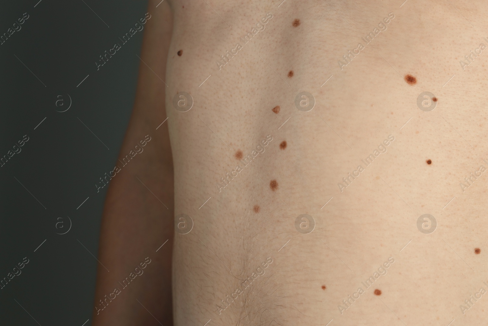 Photo of Man with birthmarks on his skin against grey background, closeup