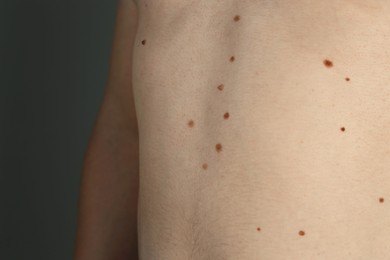 Man with birthmarks on his skin against grey background, closeup