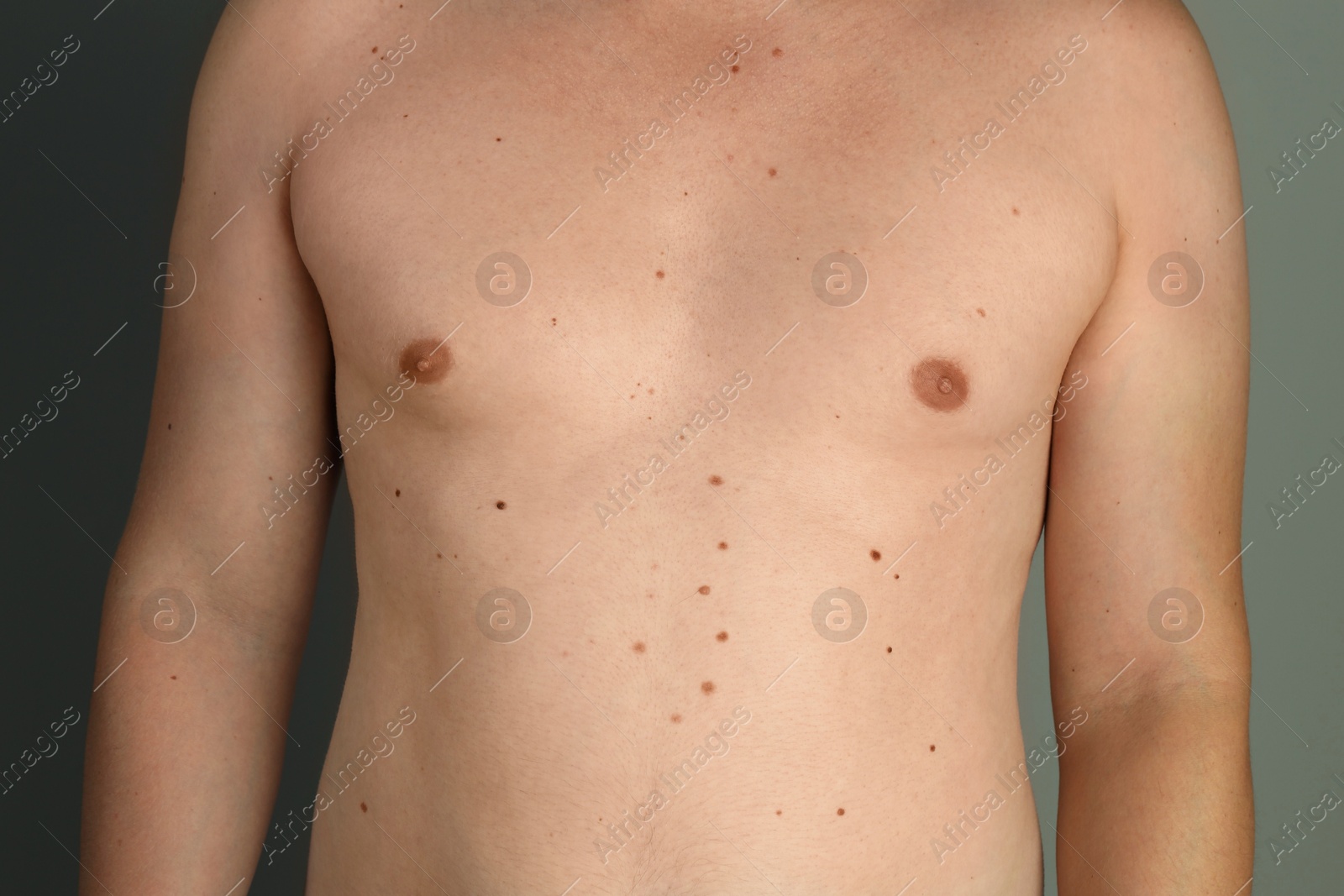 Photo of Man with birthmarks on his skin against grey background, closeup