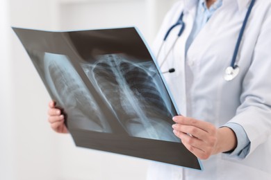 Photo of Lung disease. Doctor examining chest x-ray in clinic, closeup