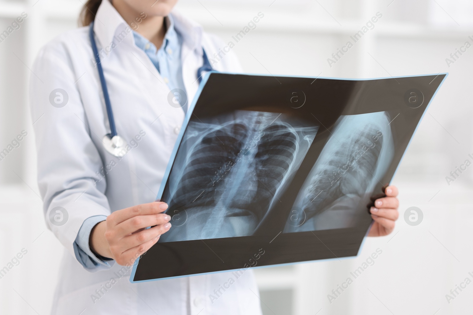 Photo of Lung disease. Doctor examining chest x-ray in clinic, closeup