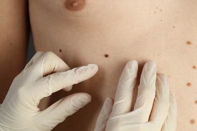 Dermatologist in gloves examining patient's birthmark, closeup