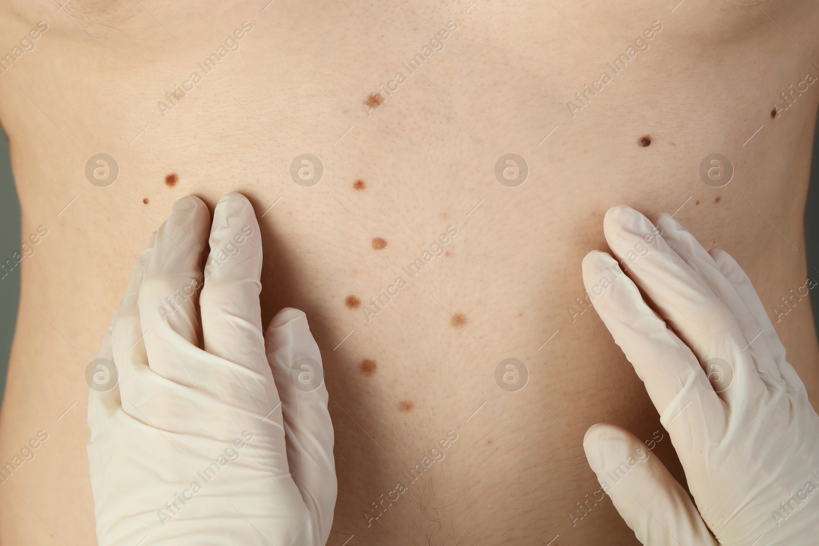 Photo of Dermatologist in gloves examining patient's birthmarks, closeup