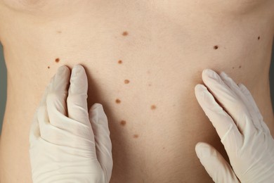 Dermatologist in gloves examining patient's birthmarks, closeup