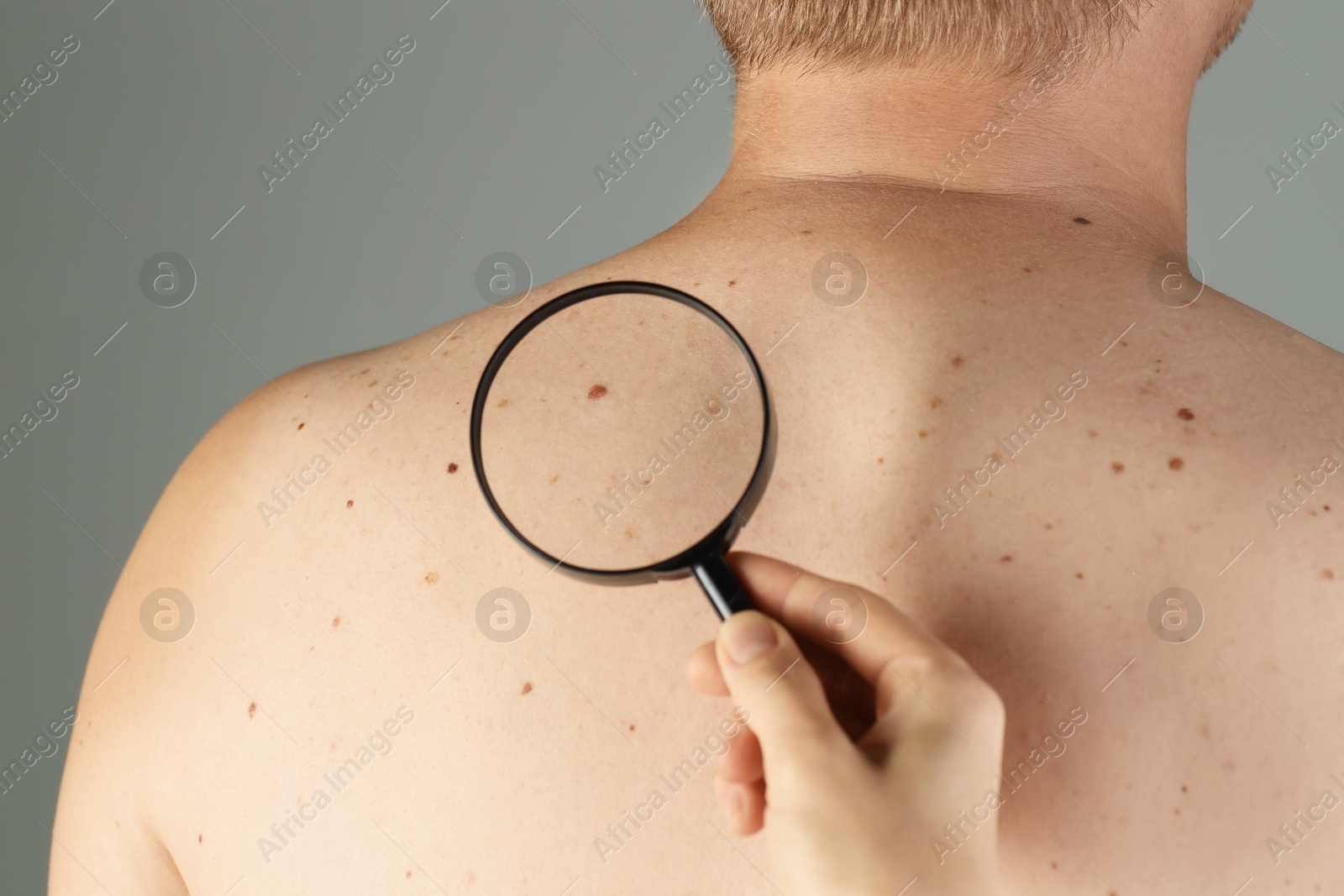 Photo of Dermatologist examining patient's birthmark with magnifying glass on grey background, closeup