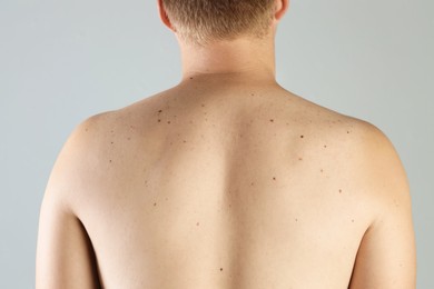 Man with birthmarks on his skin against grey background, closeup