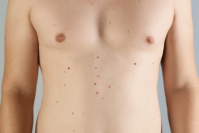 Photo of Man with birthmarks on his skin against grey background, closeup