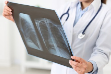 Photo of Lung disease. Doctor examining chest x-ray in clinic, closeup