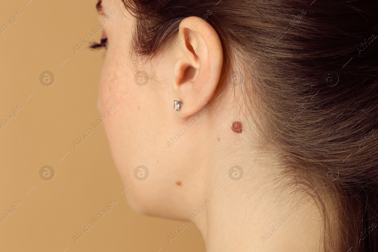 Photo of Woman with mole on her skin against beige background, closeup