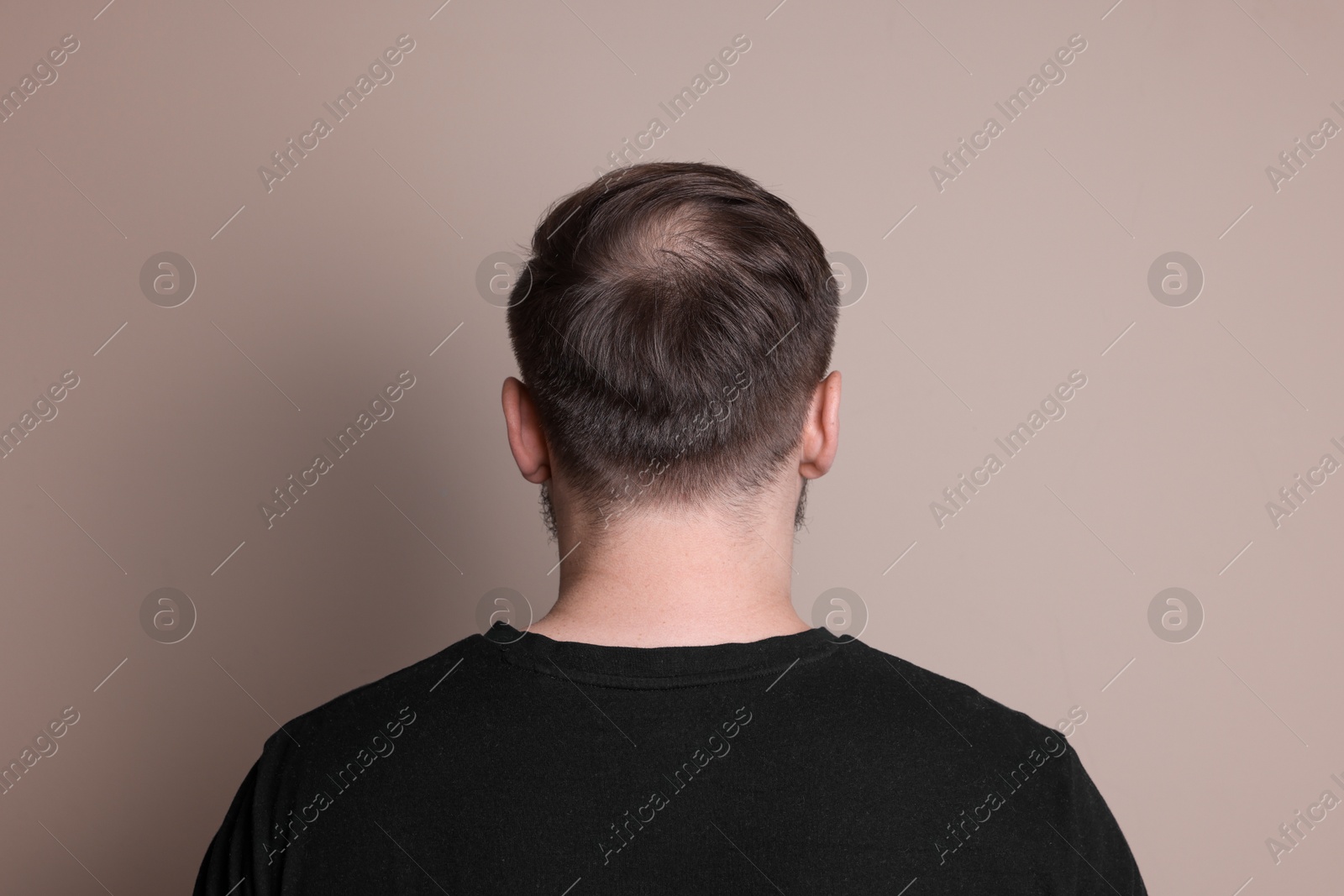 Photo of Baldness concept. Man with bald spot on beige background, back view