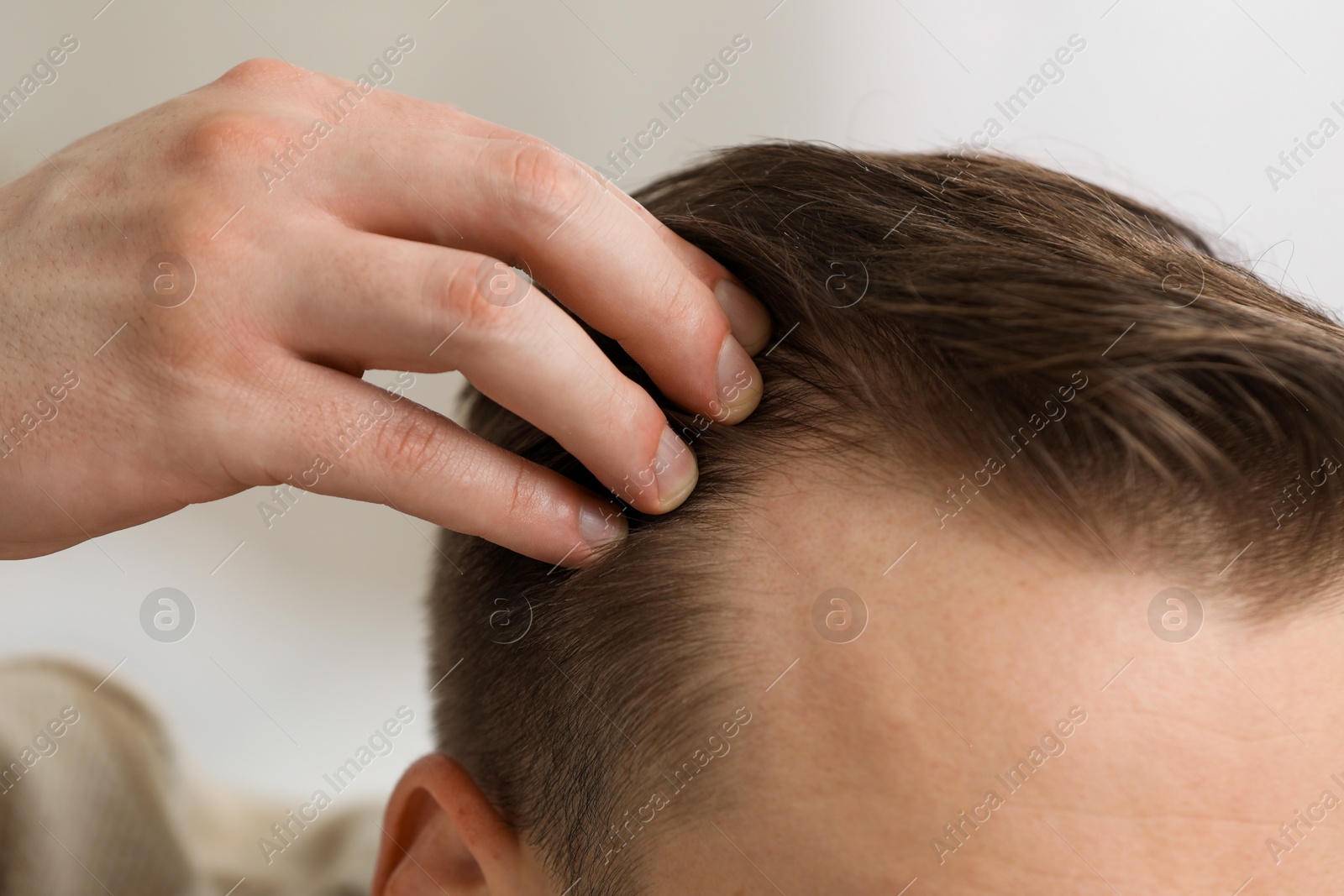 Photo of Baldness concept. Man with receding hairline indoors, closeup