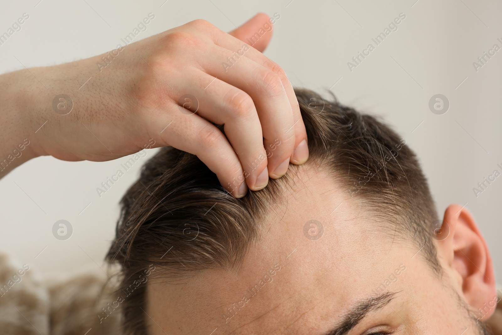 Photo of Baldness concept. Man with receding hairline indoors, closeup