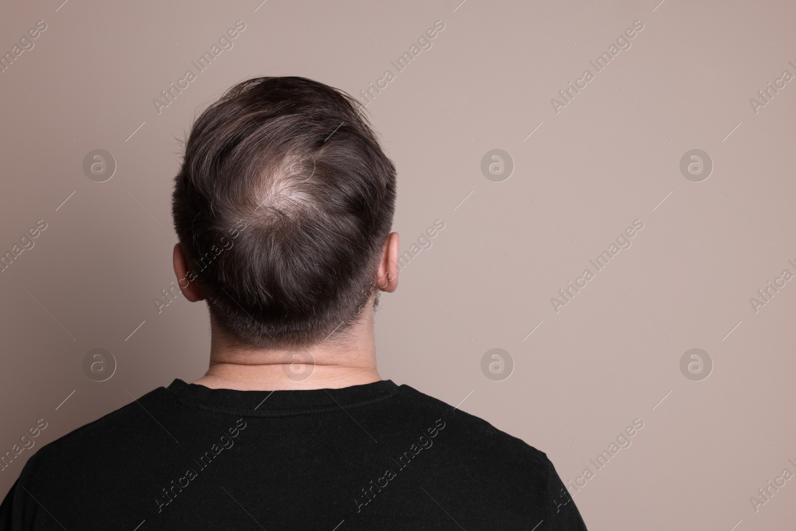 Photo of Baldness concept. Man with bald spot on beige background, back view. Space for text