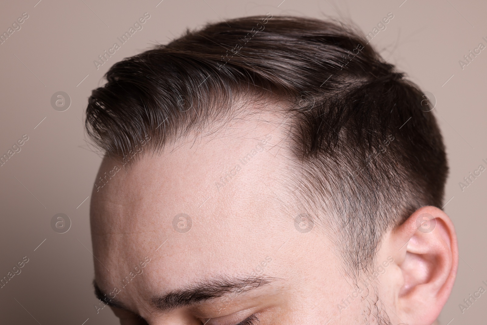 Photo of Baldness concept. Man with receding hairline on beige background, closeup